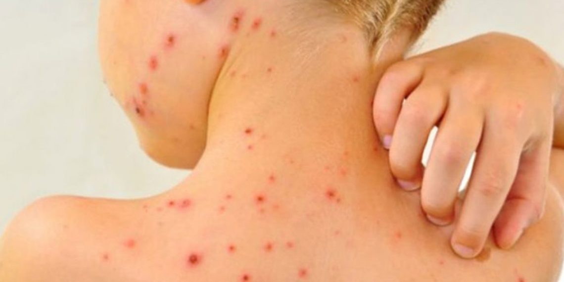 Rujeola din ”tabăra” de la Morenii Noi ar fi adusă tocmai din Bolgrad, Ucraina