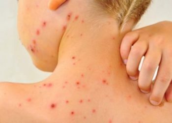 Rujeola din ”tabăra” de la Morenii Noi ar fi adusă tocmai din Bolgrad, Ucraina