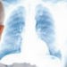 Tuberculoza între rapoarte și adevăr, la Ungheni încă predomină nepăsarea