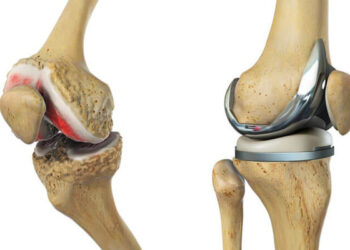 Aproape 10 mii de pacienți, în rând pentru proteze gratuite
