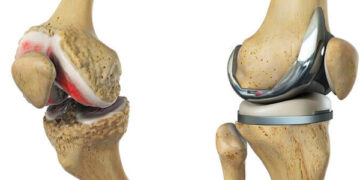 Aproape 10 mii de pacienți, în rând pentru proteze gratuite