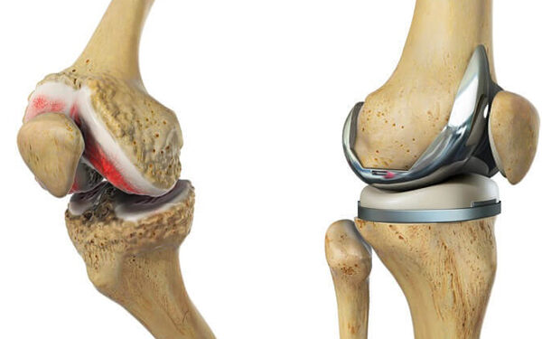 Aproape 10 mii de pacienți, în rând pentru proteze gratuite
